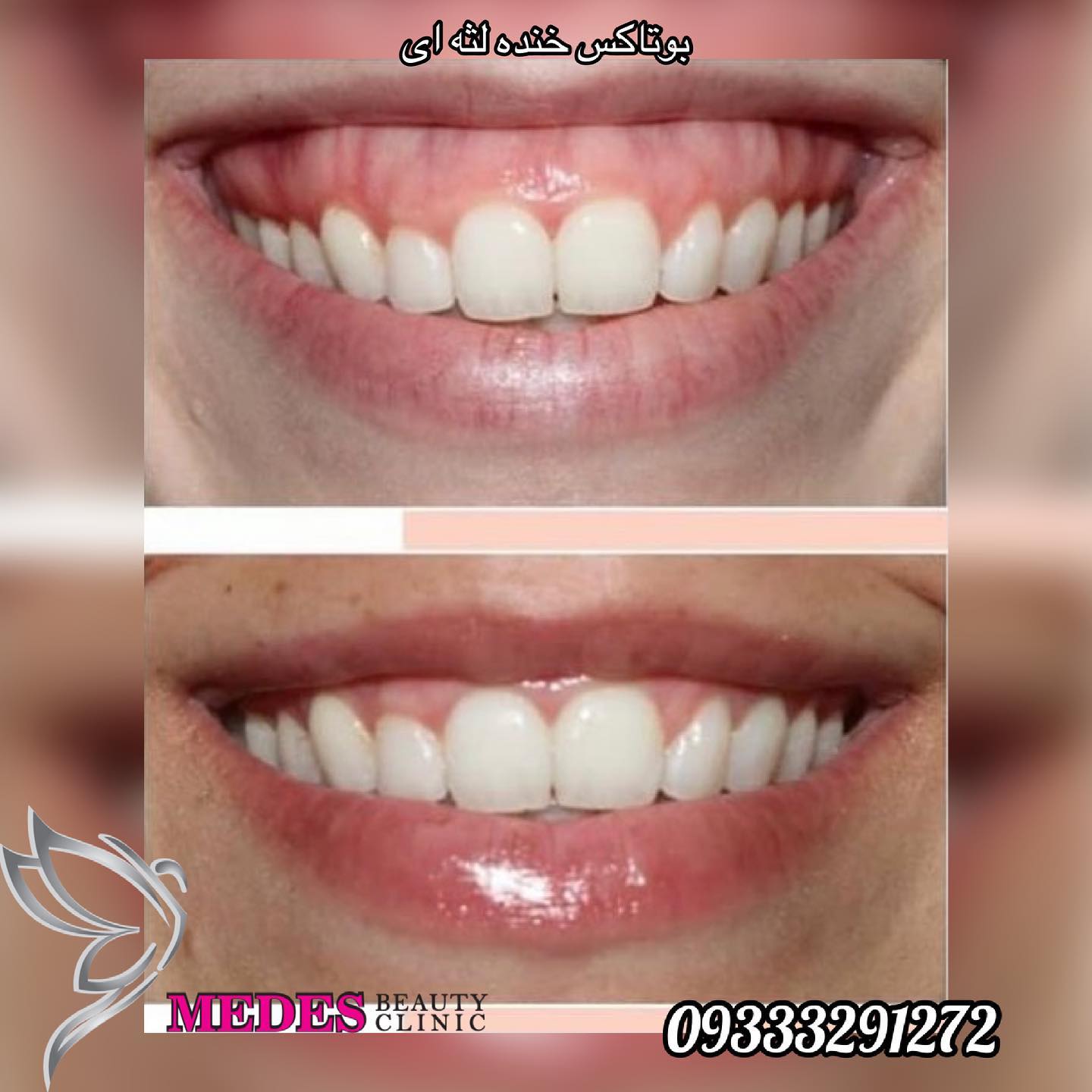 گالری تزریق بوتاکس